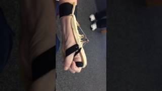 Radial Nerve Palsy splint [upl. by Lsil]