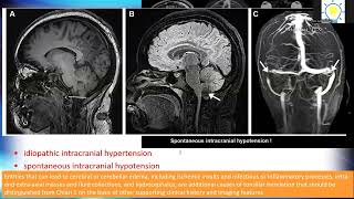 Chiari I Deformity Beyond 5 mm below the Foramen Magnum part 2 [upl. by Rape]