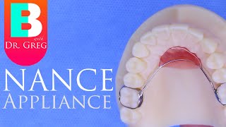 Nance Appliance during Braces [upl. by Akienahs]