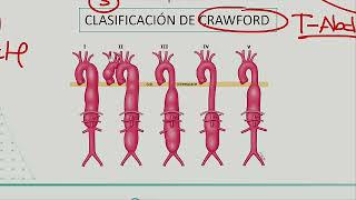 Cirugía de tórax y cardiovascular  Insuf mitral tumores mediastino aneurisma diseccion de aorta tor [upl. by Nairehs]