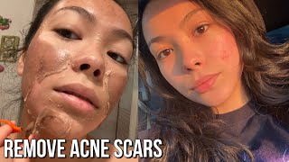 First Chemical Peel Experience  Results Before amp After [upl. by Cory839]