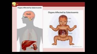 CLASE 11 metabolismo de la galactosa galactosemias [upl. by Adnah]