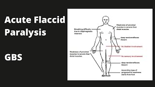 Acute Flaccid Paralysis  Guillain Barrie Syndrome [upl. by Odranoel]