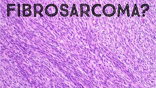 Fibrosarcoma amp Herringbone Pattern Explained in 5 Minutes pathology sarcoma dermpath [upl. by Niffirg437]