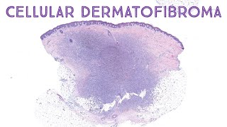 Cellular dermatofibroma dermpath pathology dermatology [upl. by Fahey916]