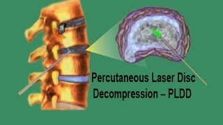 PLDD  Percutaneous Laser Disc Decompression [upl. by Nylatsyrc]