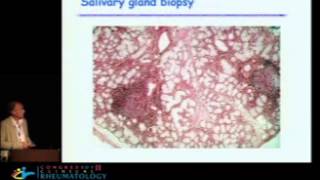 Update on Sjogrens syndrome from pathogeny to treatment  Xavier Mariette MD PhD [upl. by Pascal]