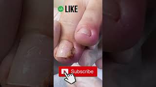 GIANT INGROWN TOENAIL😵 GROS ONGLE INCARNE😵 shorts [upl. by Quintana]