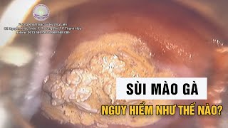 Papillomavirus ở người  Sùi mào gà  có nguy hiểm không II Bác Sĩ Hương Liên [upl. by Oinafipe]