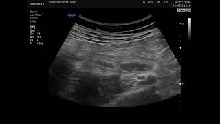 Acute Appendicitis Ultrasound Scan [upl. by Richers]