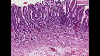 Histopathology StomachAtrophic gastritis [upl. by Enerual]