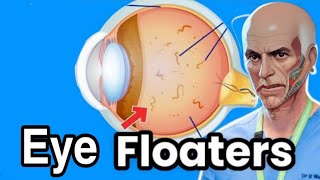 Eye Floaters and Flashes What You Need to Know [upl. by Watt]