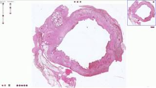 Chronic Cholecystitis  Histopathology [upl. by Hnirt]