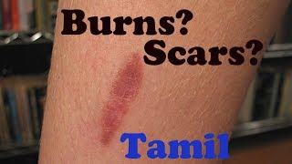 How to treat Burns and Scars  Tamil [upl. by Friedlander]