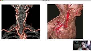 Artérias do Pescoço e da Cabeça [upl. by Rellek452]