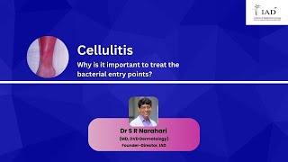 Cellulitis Treatment of bacterial entry points  Dr S R Narahari  Institute of Applied Dermatology [upl. by Nylrahs]