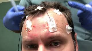 How to apply conductive gel to electrodes for athome EEG [upl. by Yablon175]