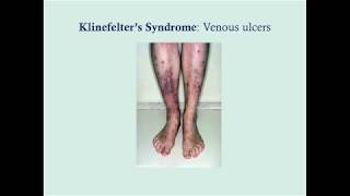 Klinefelters Syndrome  CRASH Medical Review Series [upl. by Onyx849]