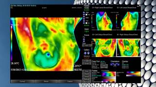 Anthony Thermography Software [upl. by Hnoj]