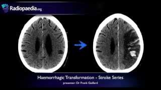 Stroke Haemorrhagic transformation  radiology video tutorial CT MRI [upl. by Anabahs205]