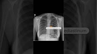 Pneumomediastinum and subcutaneous emphysema [upl. by Diet]