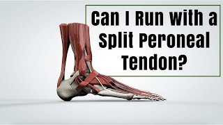 Can I Run with a Split Peroneal Tendon [upl. by Amberly214]