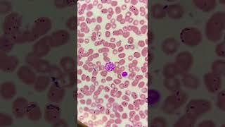 Malaria parasite under microscopePlasmodium vivax trophozoite ring and gametocytesmicroscopy [upl. by Ramilahs547]