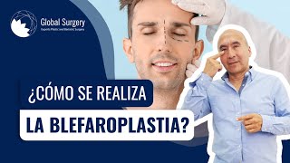 ¿Cómo se realiza la blefaroplastia 💎 [upl. by Notyal736]