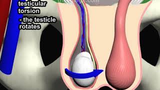 Testicular Torsion Animation by Cal Shipley MD [upl. by Dreeda]