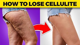 Cellulite Be Gone Dr Bergs Expert Tips on Losing Thigh and Buttock Cellulite [upl. by Esinev]