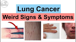 Lung Cancer Weird Signs and Symptoms  Paraneoplastic Syndromes of Lung Cancer [upl. by Starlin]