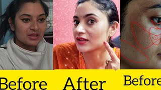 Cureskin Ke Products ne Kitna Kaam kia  My Honest review on Cureskin App [upl. by Lodhia]