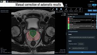 RadiologyPlatform  Automated segmentation of the prostate gland using AIbased algorithms [upl. by Addi]