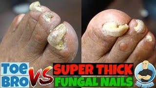 Trimming of Super Thick Fungal Nails FULL TREATMENT [upl. by Reld]