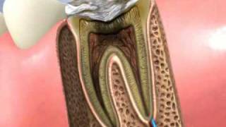 Traitement canal dentaire et pose dun inlaycore [upl. by Inol]