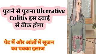 ulcerative colitis Treatment  Diet and yoga  Best Homeopathic medicine for U colitis  dr tarun [upl. by Akehsyt]