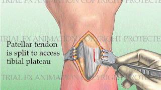 Tibial Fracture repair with Titanium Intramedullary Rod [upl. by February]