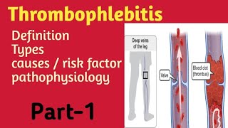 thrombophlebitis in hindi lecture  types  causes amp risk factor  pathophysiology  Part1 [upl. by Clim]