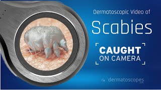 Dermoscopy of Crusted Scabies [upl. by Radcliffe925]