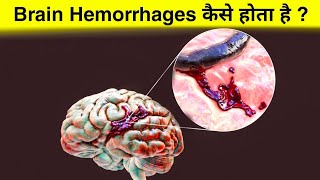 ब्रेन हेमरेज क्या है  ये कैसे होता हैं  how brain hemorrhage occurs [upl. by Nnahaid]