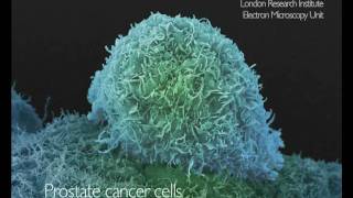 What Does Cancer Look Like  Cancer Research UK [upl. by Anerbas]