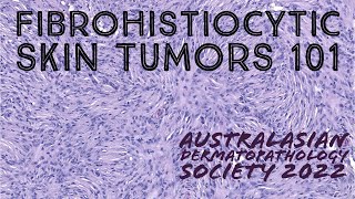 Fibrohistiocytic Skin Tumors 101 Australasian Dermatopathology Society 2022 meeting pathology [upl. by Hunt688]