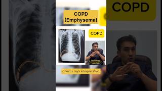 COPD chest x ray emphysema xray radiology usmle radiologist pmcmbbs biology medicalprescri [upl. by Kallick]