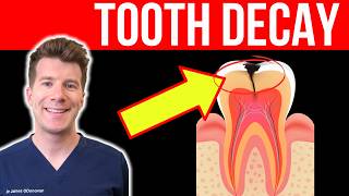 Doctor explains TOOTH DECAY TOOTH CAVITY  Causes Symptoms and Treatment [upl. by Beuthel539]