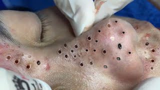 Treatment of Blackheads and Hidden Acne at Sac Dep Spa 133 [upl. by Swerdna]