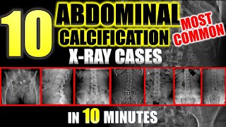 Abdominal Calcifications on XRay  10 Most Common radiology [upl. by Nura]