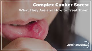 Complex Canker Sores What They Are and How to Treat Them [upl. by Bradley]