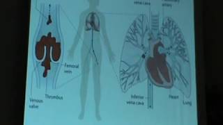 Pulmonary Embolism part one [upl. by Volnay]