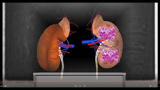 LDL Apheresis in FSGS [upl. by Gaul]