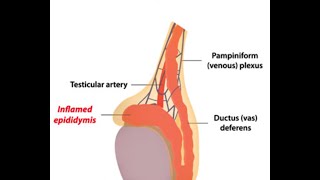 Epididymitis [upl. by Nnad]